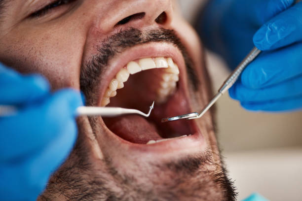 Best Emergency Tooth Extraction in Oakdale, LA